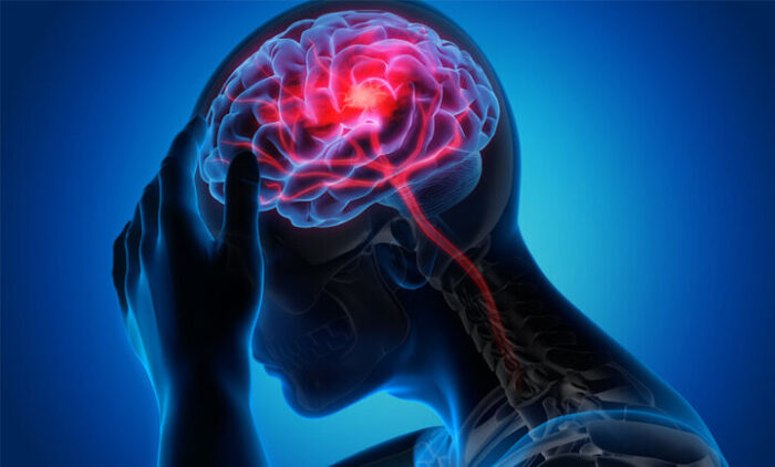تحریک نخاع به بازیابی قدرت بازو پس از سکته مغزی کمک می کند